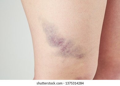 bruise varicose)