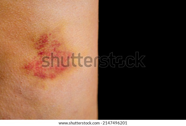 Bruises On Human Body Severe Bruise Stock Photo Shutterstock