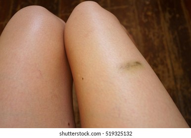Bruise Leg Images, Stock Photos Vectors | Shutterstock