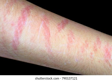 Bruise On Hand Images, Stock Photos & Vectors | Shutterstock