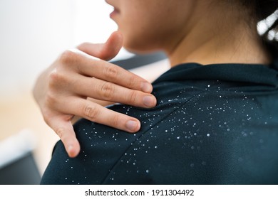 Brushing White Dandruff Fallen From Itchy Hair