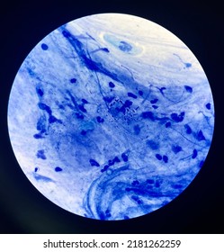 Budding Yeast Cells In Sputum Gram Stain.