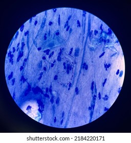 Budding Yeast Cells In Sputum Gram Stain.