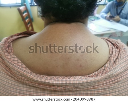 Buffalo hump, swelling at the nape in patient with Cuahing Disease.