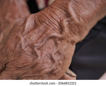 Bulging Skin And Blood Vessels. An Old Man Of About 80 Years Old With Veins And Wrinkles On His Skin. Close Up Shot Of A Senior Man .varicose Veins On The Skin. Wrinkly Skin Texture On Back Side ,