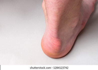 haglund's deformity heel