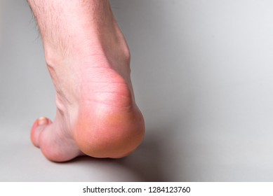 free haglund's deformity