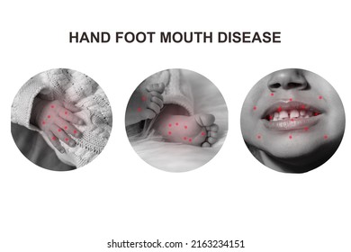 A Bunch Of Hand Foot Mouth Disease. Set Of Baby Body Details In Circles Isolated On White Background. Modern Line Art Collage