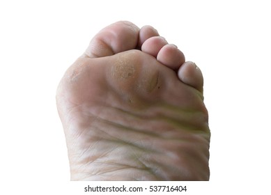 Bunion Stock Photo Shutterstock