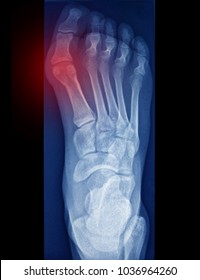 Bunion, Foot Pain, X Ray Image