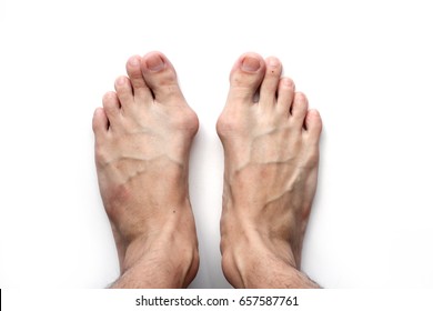 Bunion In Foot Problem