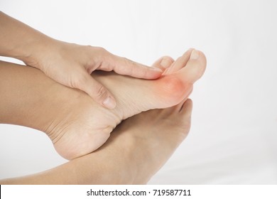 Bunion In Foot Problem