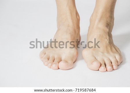 bunion in foot problem