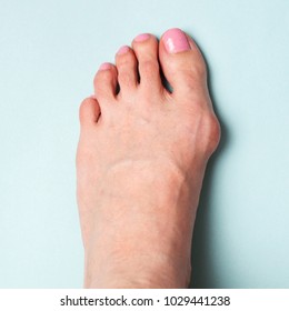 Bunion In Foot. Valgus Deformation From Narrow Shoes.