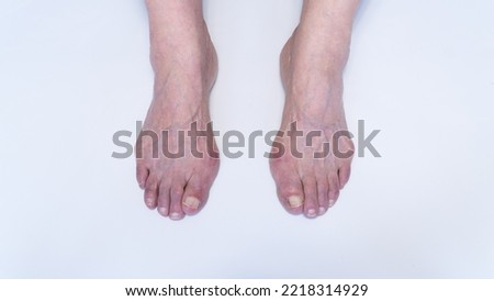 Bunion or hallux valgus on senior woman foot. Deformity of the joint connecting the big toe to the foot. Skeletal disorder on old woman body.