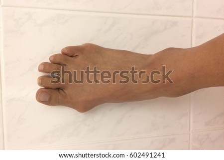bunion right foot