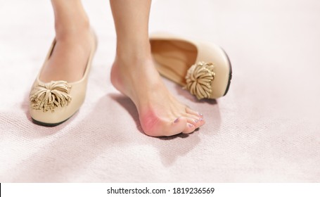 Bunions Symptoms (Hallux Valgus), Woman Feet Problem, Pain, Hurt, Callus Blisters. Closeup, A Beautiful Woman Taking Off Her Tight And Narrow High Heels Shoes To Rest Her Sore And Painful Hammertoes. 