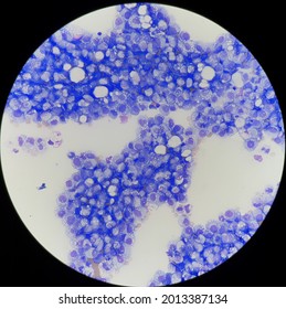 Burkitt's Lymphoma In Body Fluid.