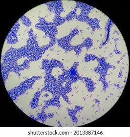 Burkitt's Lymphoma In Body Fluid.