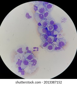 Burkitt's Lymphoma In Body Fluid.