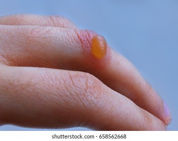 A Burn Blister On The Hand