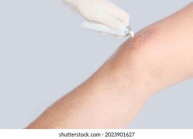 Burn. A Hand In A Medical Glove Is Applying Ointment To A Wound On The Leg Of A Caucasian Male. First Aid, Cospace. Grey Background