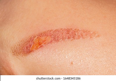 Burn Mark On The Skin Of The Hand