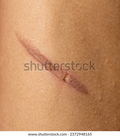 burn on hand as background