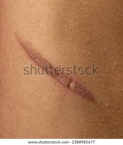 burn on hand as background