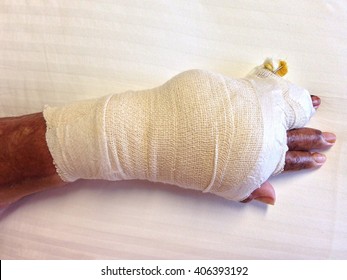 Burn Patient Hand In Bandages With Skin Graft And K Wire Inserted On Little Finger After A Contracture Release Surgery.