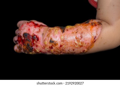 Burn Wound Surrounded By Scabs And Exsudates In Hand And Forearm Of Southeast Asian Child. Closeup View.