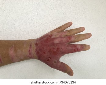 Burned Or Burnt Mans Hand.Heavy Skin Damage