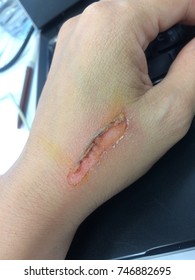 Burns on forearm skin