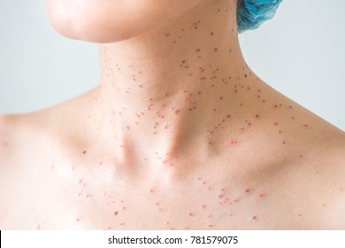 Liver Spots Images Stock Photos Vectors Shutterstock