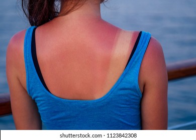 burnt female skin in the sun close-up in a blue t-shirt
