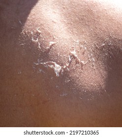 Burnt Skin On The Back Of A Man. Background