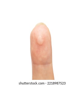 Burnt Skin On The Finger