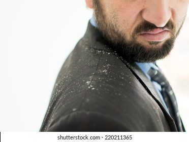 Business Man Having Man Dandruff In The Hair