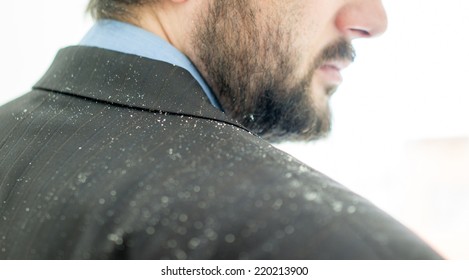 Business Man Having Man Dandruff In The Hair