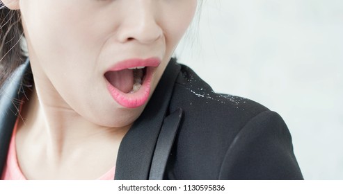 Business Woman With Dandruff Problem For Your Health Concept