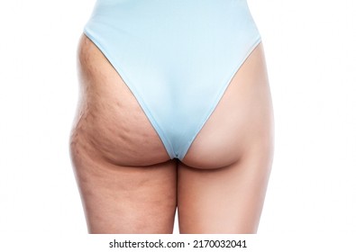 Buttocks and legs of a fat woman with cellulite and stretch marks before and after losing weight. Overweight treatment. - Shutterstock ID 2170032041