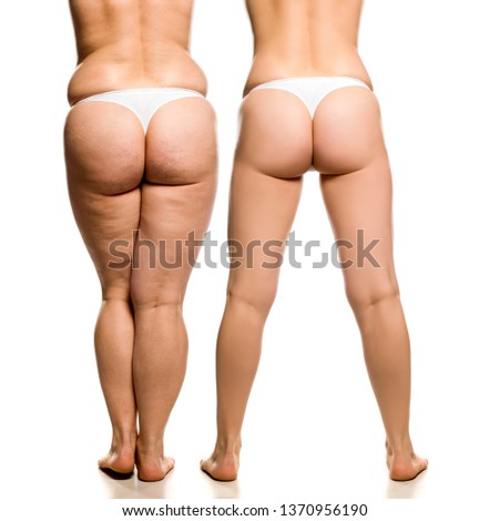 Buttocks, legs and waist of overweight woman before and after liposuction on white background