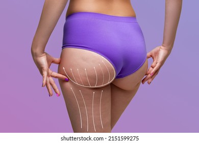 Buttocks liposuction, fat and cellulite removal concept, overweight female body with painted surgical lines and arrows on a purple background with a gradient