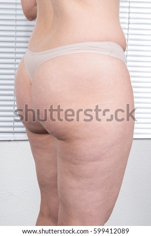 buttocks of a woman round with cellulite