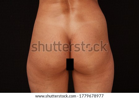 buttocks of a young woman giving birth with age-related changes and cellulite. concept for medicine and cosmetology.