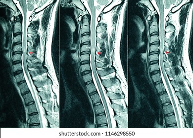 C- Spines MRI Scan Of A Patient With Chronic Upper Extremities Weakness Showing Herniated Nucleus Pulposus At C4-C5 Levels. Chronic Neck Pain. Cervical Disc Herniation.  Cord Compression Lesion.