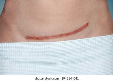 Caesarean Scar After Surgery Because Baby Stock Photo 1946144041 ...