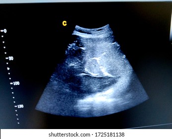 Calcification In Placenta By Ultrasound Scan