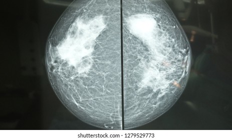Calcifications seen on Mammogram suggestive of Malignancy