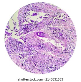 Calcinosis cutis of histology image analyzed by light microscope.